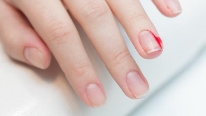 Atasi Kuku Cantengan dengan 5 Cara Alami Berikut Ini