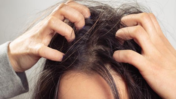 Banyak yang Belum Tahu, Ini 5 Cara Alami untuk Menghilangkan Ketombe