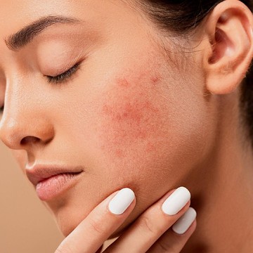 Sering Kesal dengan Jerawat dan Bekasnya? Coba Pakai Azelaic Acid