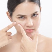 Vitacid dan 5 Salep Jerawat Ampuh, Bye Jerawat!