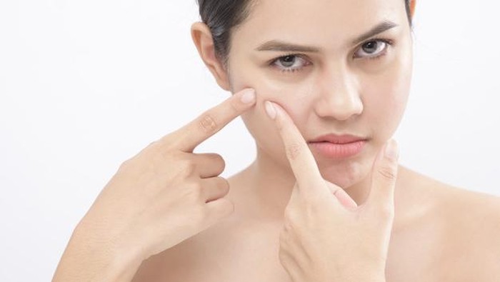 Vitacid dan 5 Salep Jerawat Ampuh, Bye Jerawat!