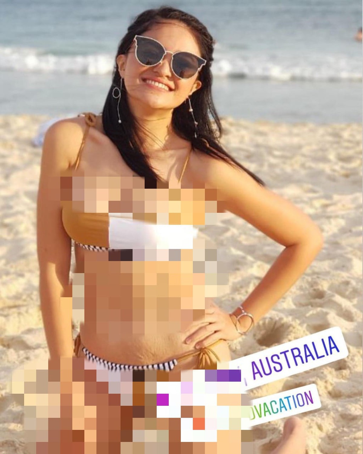 Strech mark di perut marshanda