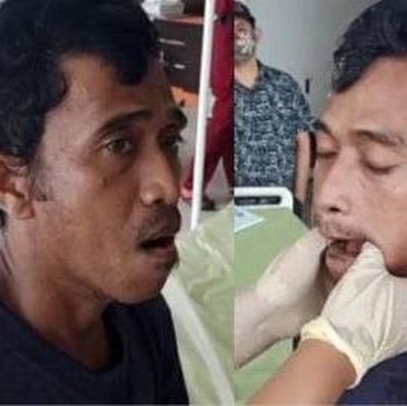 Aduh, Pria Ini Tak Bisa Mingkem karena Ketawa & Menguap Terlalu Lebar