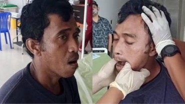Aduh, Pria Ini Tak Bisa Mingkem karena Ketawa & Menguap Terlalu Lebar