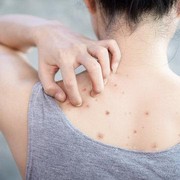 5 Body Wash yang Ampuh Mengatasi Jerawat di Punggung