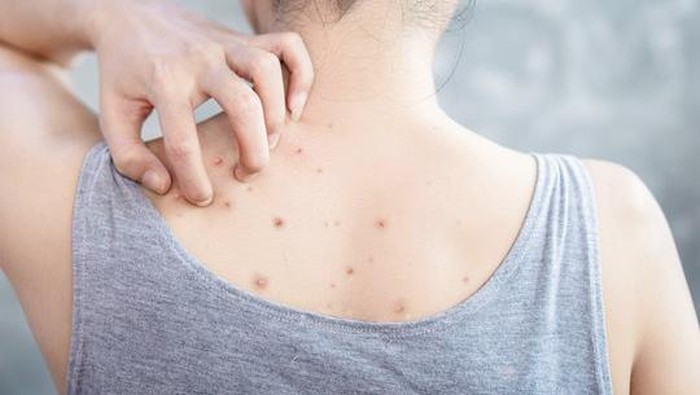 5 Body Wash yang Ampuh Mengatasi Jerawat di Punggung