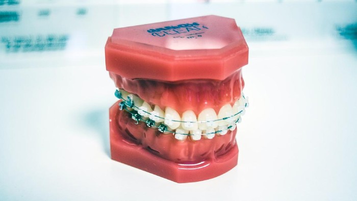 Pasang Behel Gigi Tidak Bisa Sembarangan! Ini Dampak Buruk Memaksa Pasang Behel Sendiri Pasang Behel Gigi Tidak Bisa Sembarangan! Ini Dampak Buruk Memaksa Pasang Behel Sendiri