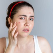 Ladies, Hindari Kandungan Makeup Ini yang Memicu Timbulnya Jerawat