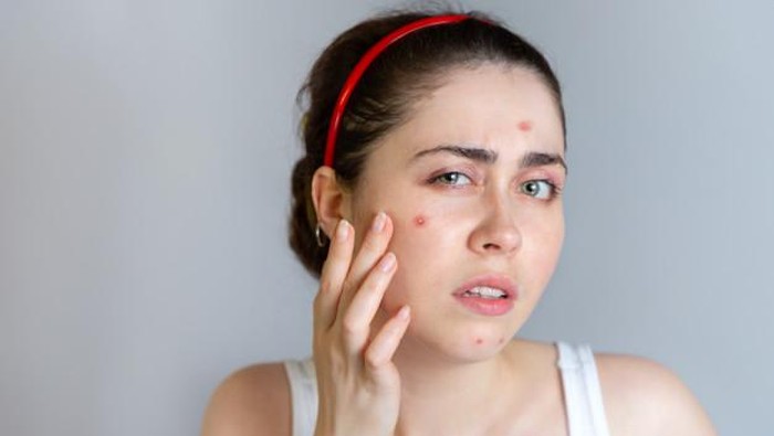 Ladies, Hindari Kandungan Makeup Ini yang Memicu Timbulnya Jerawat Ladies, Hindari Kandungan Makeup Ini yang Memicu Timbulnya Jerawat
