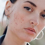 Mengatasi Jerawat Pakai Es Batu, Pernah Coba?