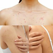 Rajin Mandi tapi Jerawat Punggung Masih Sering Muncul? Mungkin Ini Penyebabnya