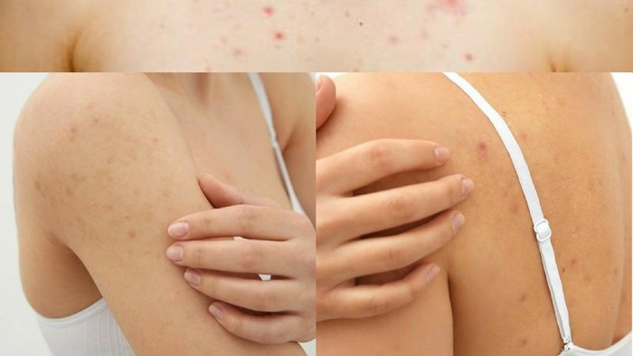 Rajin Mandi tapi Jerawat Punggung Masih Sering Muncul? Mungkin Ini Penyebabnya