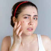 WFH Jadi Gampang Jerawatan? Cobain Rangkaian ERHA AcneAct Witch Hazel Series yuk, Ladies!