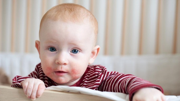 Redhead beautiful baby with atopic dermatitis
