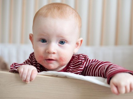 5 Penyebab Bintik Merah di Kulit Bayi Serta Cara Alami untuk Pertolong Pertama