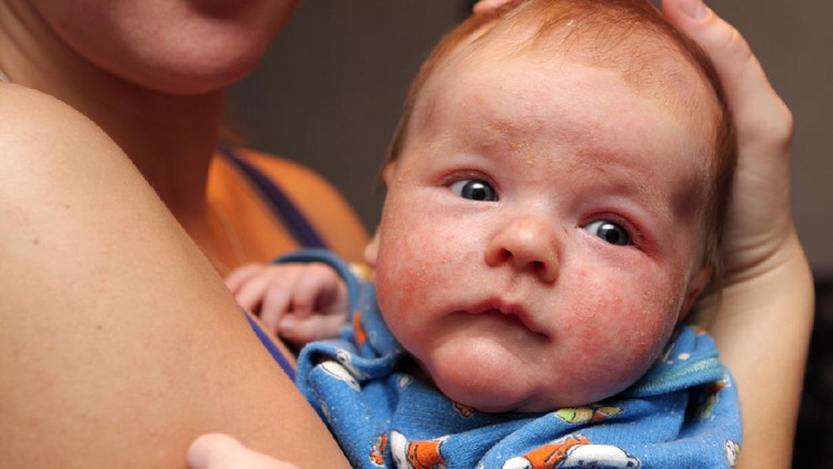 Redhead beautiful baby with atopic dermatitis