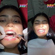 Proses 'Glow Up' Jharna Bhagwani Menggunakan Kawat Gigi