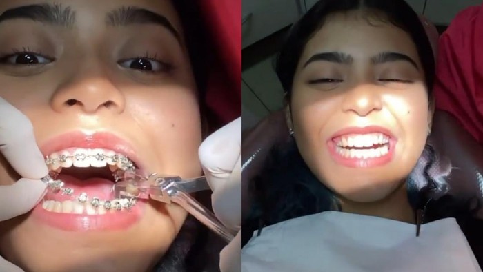 Proses 'Glow Up' Jharna Bhagwani Menggunakan Kawat Gigi