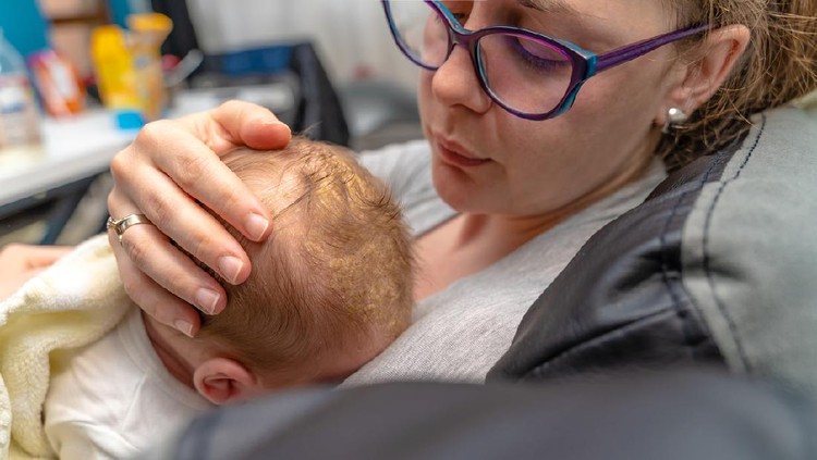 Mother looking at her newborn baby head which has dermatologic problem Cradle Cap Seborrheic Dermatitis. The baby is 2 months old and of caucasian ethnicity. The scene is situated indoors in city flat apartment located in Sofia, Bulgaria (Eastern Europe). The picture is taken with Sony A7III camera.