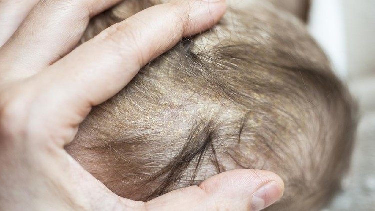Mother looking at her newborn baby head which has dermatologic problem Cradle Cap Seborrheic Dermatitis. The baby is 2 months old and of caucasian ethnicity. The scene is situated indoors in city flat apartment located in Sofia, Bulgaria (Eastern Europe). The picture is taken with Sony A7III camera.