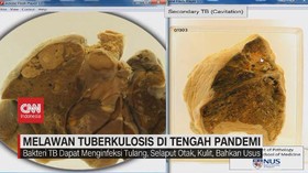 VIDEO: Melawan Tuberkulosis di Tengah Pandemi