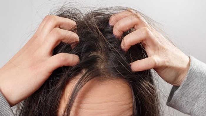 Ini Kesalahan yang Menyebabkan Rambut Kamu Jadi Kutuan!