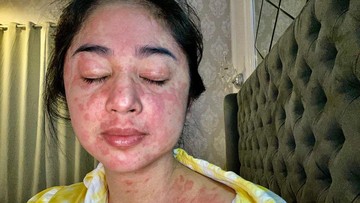 Dewi Perssik recovery usai positif COVID-19