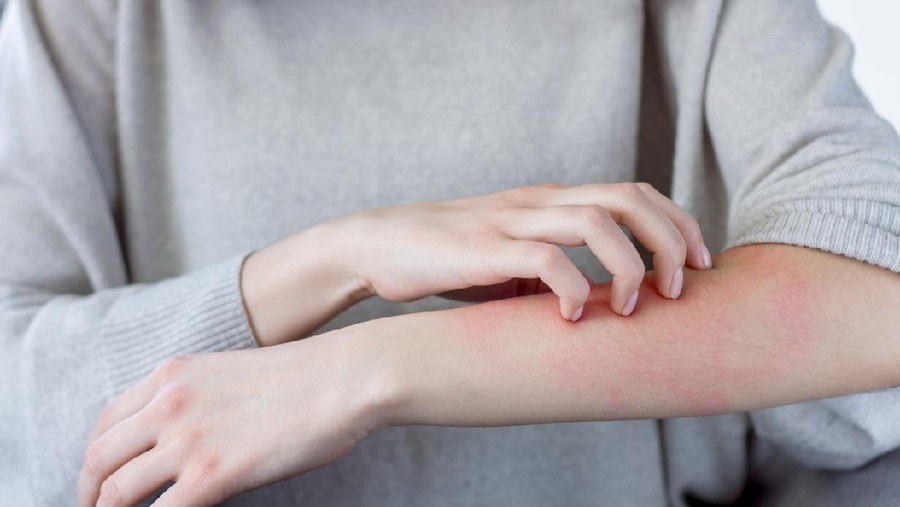 Ilustrasi ruam kulit Closeup girl is scratching her hand with nails. Reddened, inflamed body parts causes discomfort and itching. Young woman is suffering from bouts of allergies. Dermatological skin diseases concept.