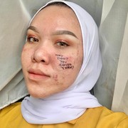 Embrace Your Self! Perempuan dengan Imperfection di Wajah Juga Punya Power