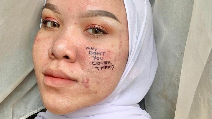 Embrace Your Self! Perempuan dengan Imperfection di Wajah Juga Punya Power