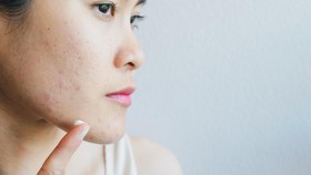 7 Jenis Jerawat, Penyebab, dan Cara Mengatasinya
