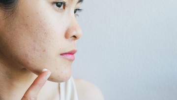 7 Jenis Makanan yang Bisa Memperparah Jerawat, Perlu Dibatasi