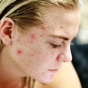 Sudah Menginjak 30 tahun Tapi Masih Jerawatan? Mungkin Itu Jerawat Dewasa!