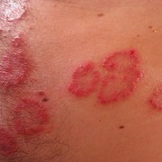 5 Penyakit Kulit Langka Berikut Ini Obatnya Susah Dicari, Hati-Hati ya!