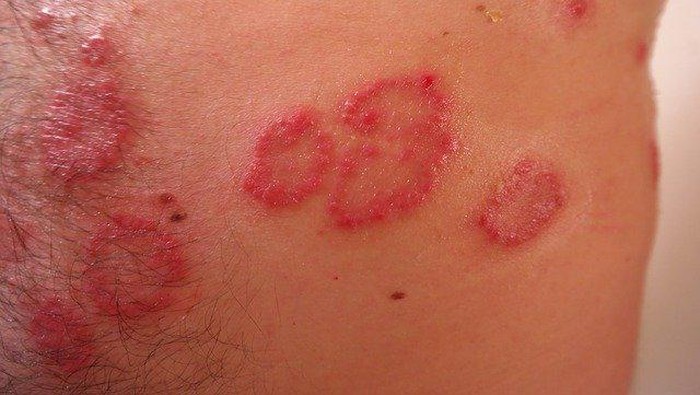 5 Penyakit Kulit Langka Berikut Ini Obatnya Susah Dicari, Hati-Hati ya!