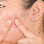 Kenali Berbagai Jenis Jerawat Agar Tak Salah Mengatasinya