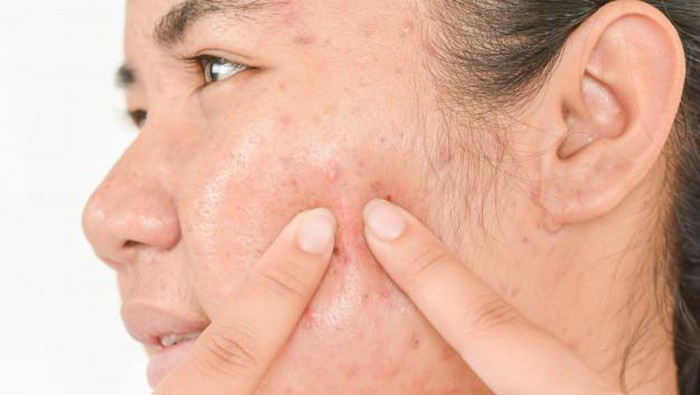 Kenali Berbagai Jenis Jerawat Agar Tak Salah Mengatasinya
