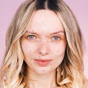 6 Rekomendasi Skincare untuk Mengatasi Rosacea yang Sering Dianggap Jerawat