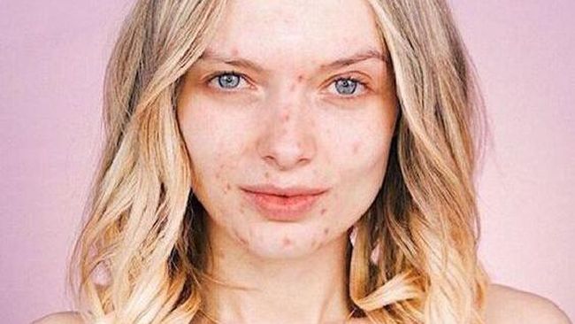 6 Rekomendasi Skincare Untuk Mengatasi Rosacea Yang Sering Dianggap Jerawat