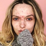 Rosacea, Masalah Kulit yang Sering Dianggap Jerawat Biasa