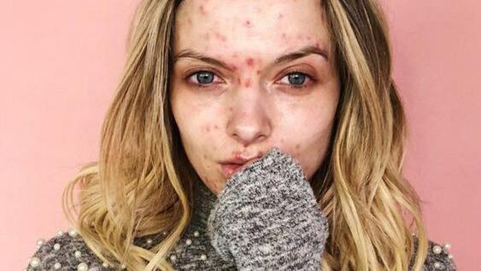 Rosacea, Masalah Kulit yang Sering Dianggap Jerawat Biasa