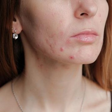 Rekomendasi Skincare untuk Redakan Maskne