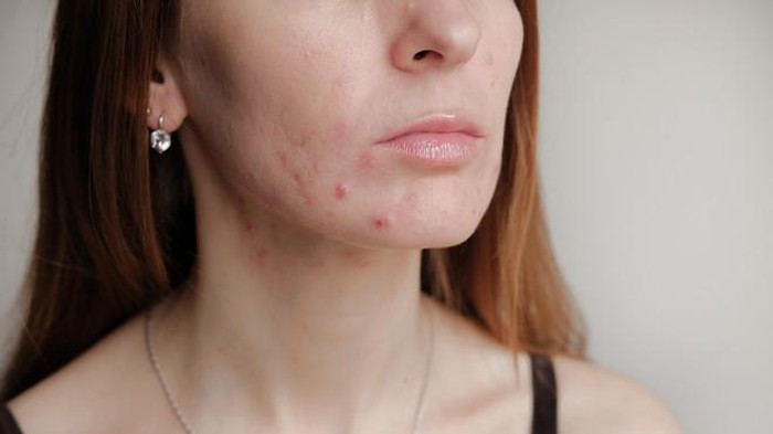 Rekomendasi Skincare untuk Redakan Maskne Rekomendasi Skincare untuk Redakan Maskne