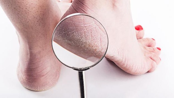 10 Cara Efektif Menghilangkan Kulit Kapalan 10 Cara Efektif Menghilangkan Kulit Kapalan