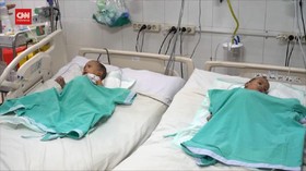 VIDEO: Kondisi Terkini Bayi Kembar Siam Adam dan Aris