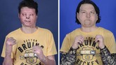 FOTO: Transplantasi Wajah dan Tangan Pertama di Dunia Joe DiMeo, penerima transplantasi ganda pertama di dunia akhirnya bisa tersenyum kembali usai mengalami kecelakaan yang menyebabkan luka bakar tingkat tiga.