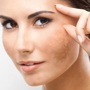 Ampuh! 5 Tips Cegah Kemunculan Flek Hitam Agar Wajah Tetap Cantik