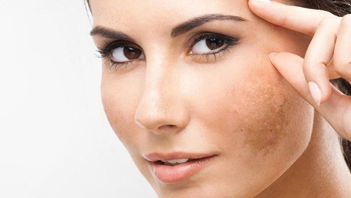 Ampuh! 5 Tips Cegah Kemunculan Flek Hitam Agar Wajah Tetap Cantik
