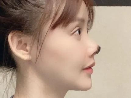 Operasi Hidung Artis Cantik China Ini Gagal, Hasilnya Bikin Ngeri