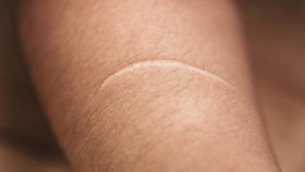 7 Cara Alami untuk Hilangkan Bekas Luka di Kulit